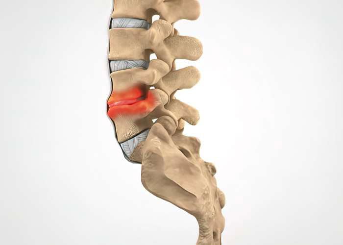 Degenerative Disc Disease What Causes Degenerative Disc Disease Ft. Worth, Texas