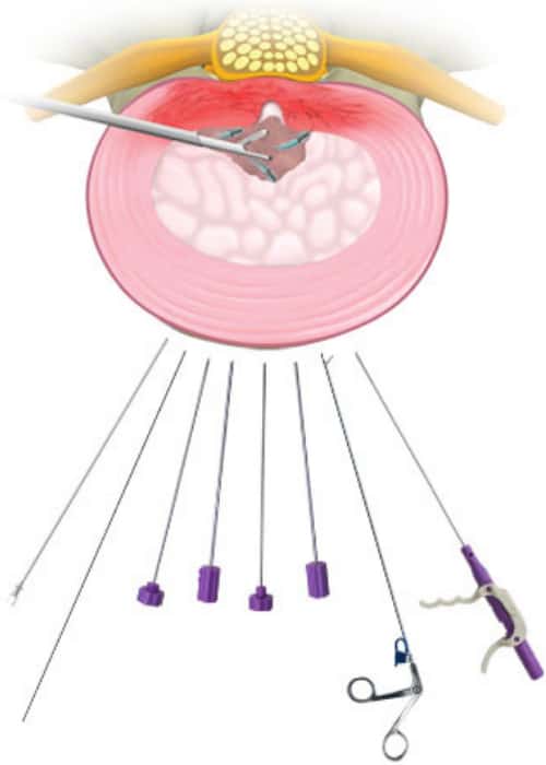 DiscFX Herniated Disc Back Pain Dallas, Fort Worth Arlington, TX