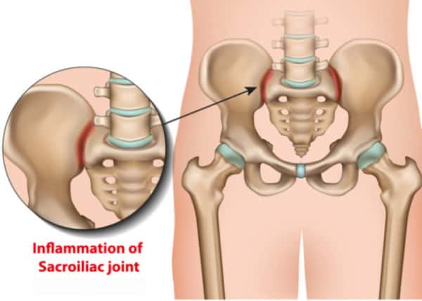 PsiF Posterior Sacroiliac Fusion System SI Joint Pain Dallas Fort Worth Arlington TX